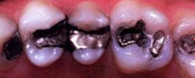 Invisalign