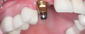 Invisalign