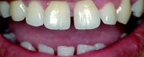 Invisalign