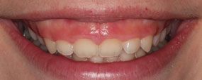 Invisalign