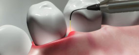 Invisalign