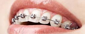Invisalign
