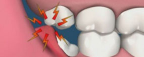 Invisalign