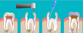Invisalign
